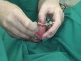 Operative urethra stretching