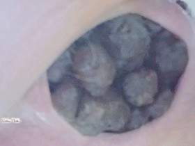Strain Huge Poop