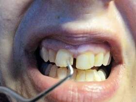 Broken incisor - real broken incisor