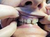 Broken incisor - real broken incisor