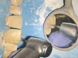 Rekonstruktion des Diastemas der Schneidezähne