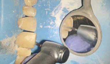 Rekonstruktion des Diastemas der Schneidezähne