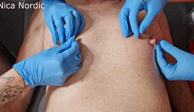 Nippelqual mit Nadeln