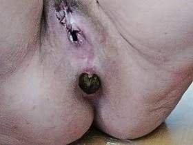 Bone-dry bolt birth, then obstetrics, finger pulls out shit