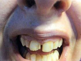 Full hd broken teeth in a very close up view