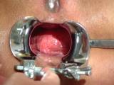 Anal Speculum 4 - Now, there is much