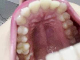 Schwäche der scharfen Zähne