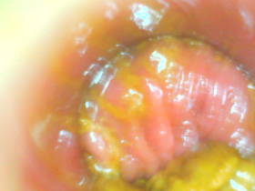 A peek in the rectum