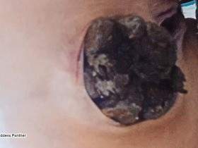 Strain Constipated Turds