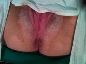 Slippery cervix