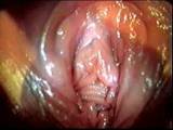 Cervix ..... and .....