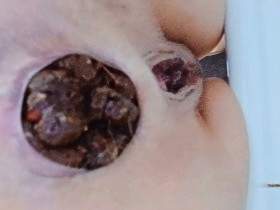  Verstopfungsdosis für Sklaven