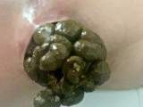 Constipated Strained Turds