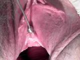 Ball rod penetrates into the bladder