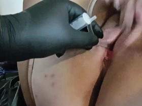 Catheter aftertreatment of the greedy cunt